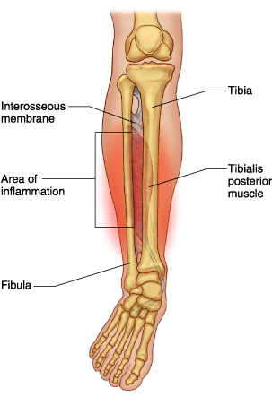 Shin Splints