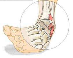 Ankle Sprain